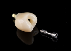 Dental implant components on a black background