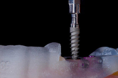 Implant Surgery: A Comprehensive Review Utilizing Freehand and Guided Techniques