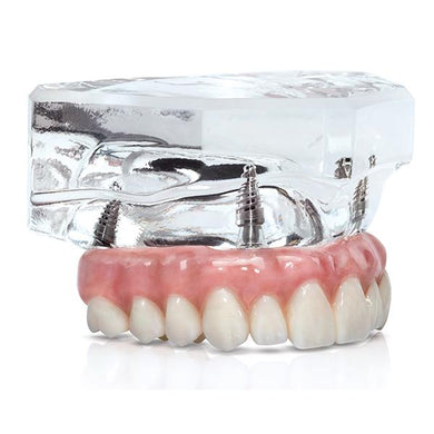 BruxZir® Implant Prosthesis Sample Clear Base w/ Implants
